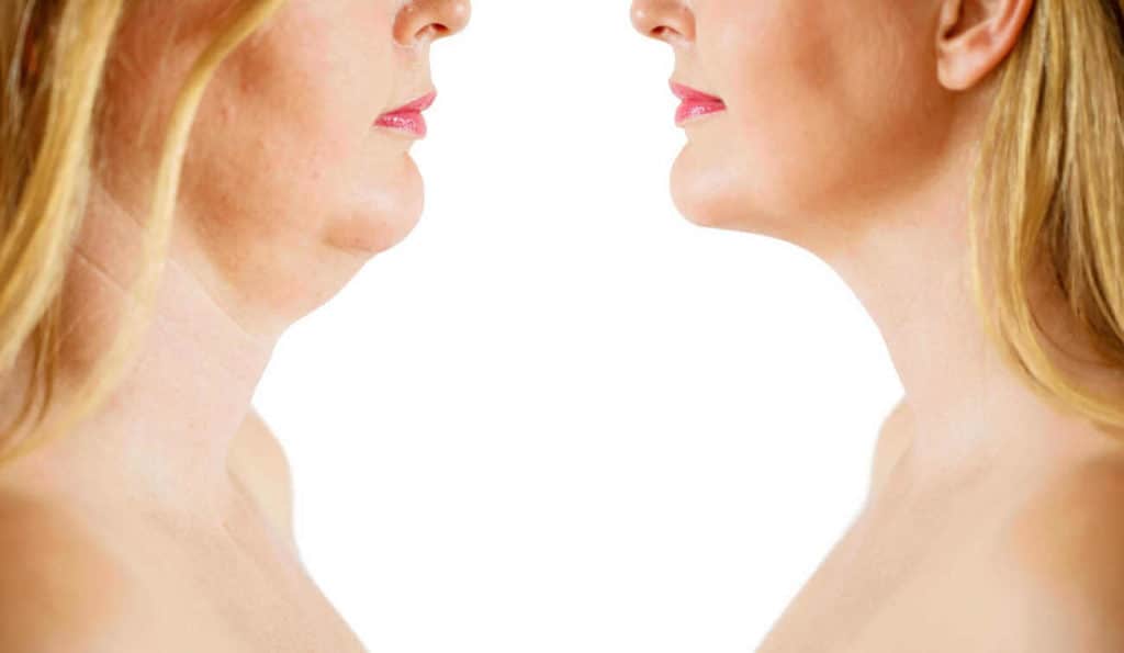 Double Chin treatment West Ham before and after results