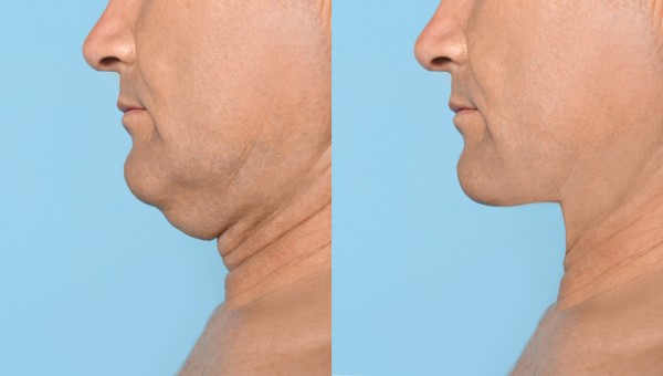 Which Non-Surgical Treatments Work Best for Jowls and Loose Skin West Ham?