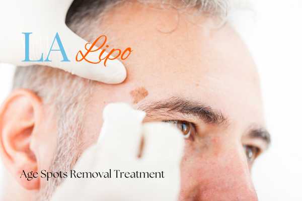 What Are the Most Effective Treatments for Age Spots West Ham?