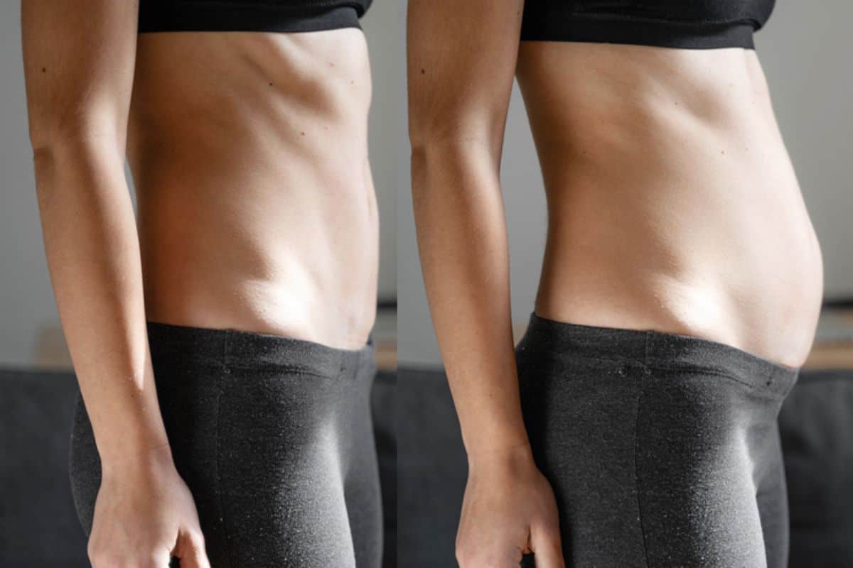 How long does diastasis recti take to improve West Ham?