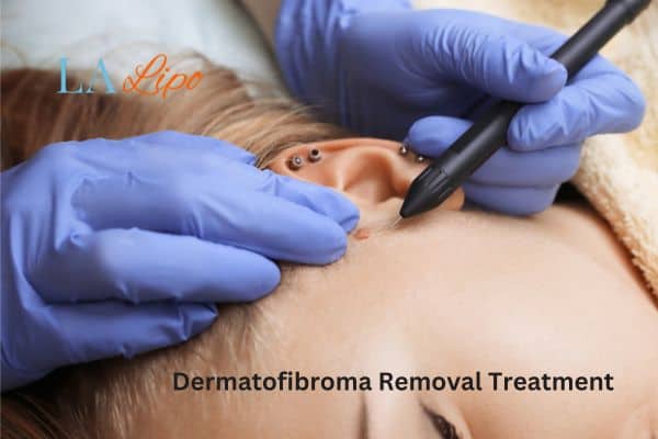 Dermatofibroma Removal Treatment West Ham