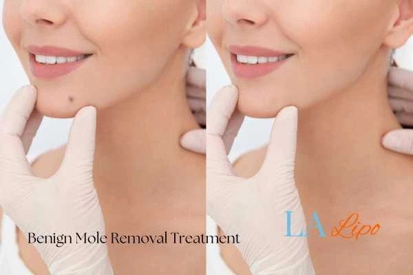 Before-and-after results following benign mole-removal treatment West Ham