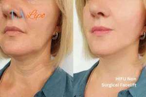 hi-fu for wrinkles West Ham before and after results