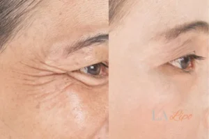 Before and after results of woman - HI-fu wrinkles reduction treatment West Ham
