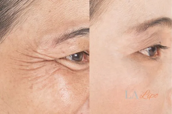 Before and after results of woman - HI-fu wrinkles reduction treatment West Ham