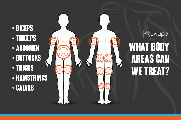 Graphic to show areas you can have LA-EMS Body Sculpting West Ham treatment.