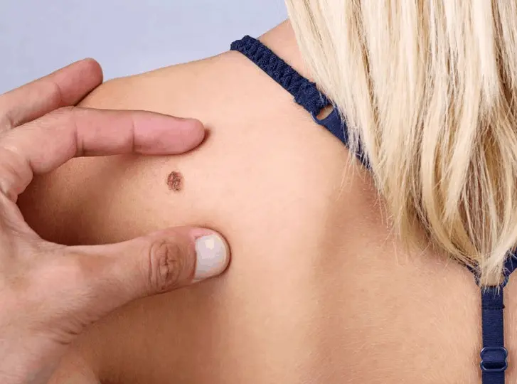 woman having mole removal West Ham consultation before treatment.