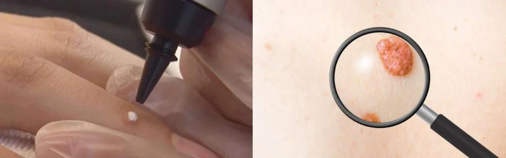 CryoPen practitioner West Ham assessing a benign mole before treatment