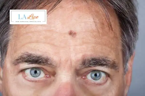 Solar Lentigo Removal West Ham image of man with mark on his forehead