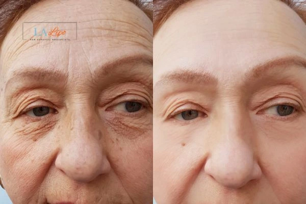 The powerful benefits of Morpheus8 Treatment West Ham - Call Our team today!