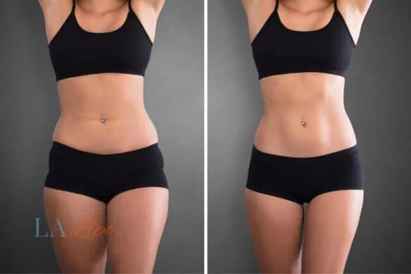before and after results of non-surgical treatment to help a woman's body image and mental health West Ham