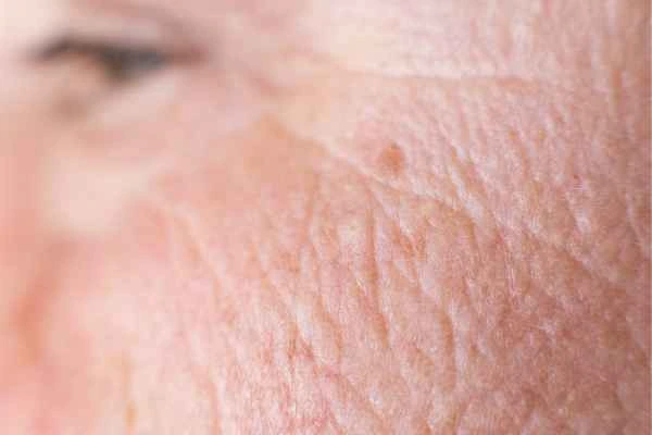 close up picture of a woman's face showing an age spot West Ham