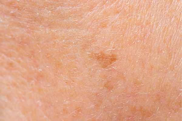 close up picture of age spots West Ham