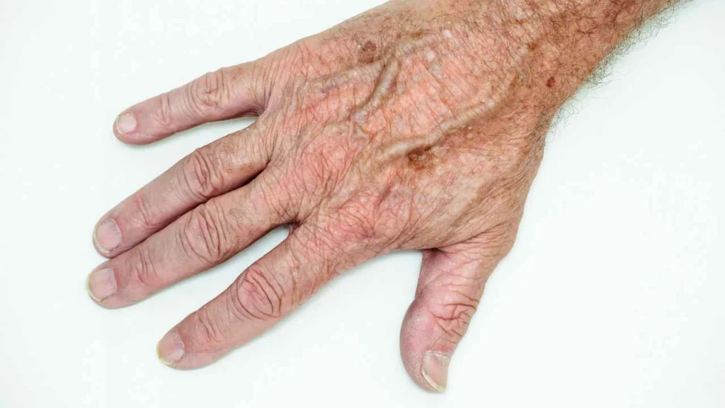 Male hand showing age spot West Ham