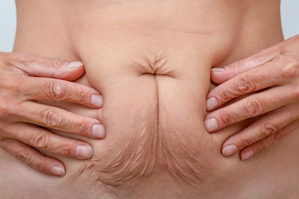 Image of a woman's stomach with loose skin - example of skin tightening West Ham options
