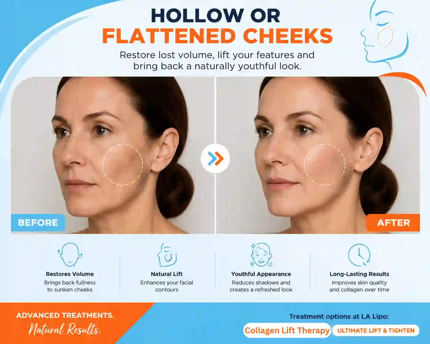 Sign #4: Hollow or Flattened Cheeks West Ham