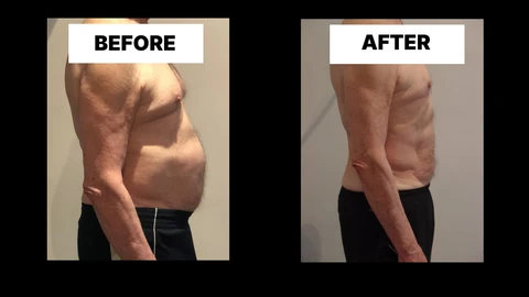 What Symptoms Can Diastasis Recti Cause in Men? Weak Core, Back Pain and Poor Posture West Ham